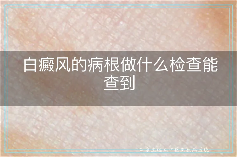 白癜风的病根做什么检查能查到