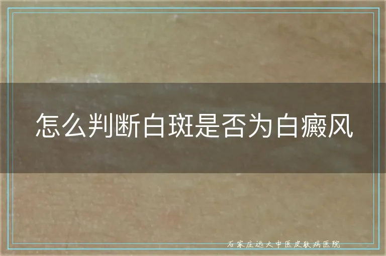 怎么判断白斑是否为白癜风