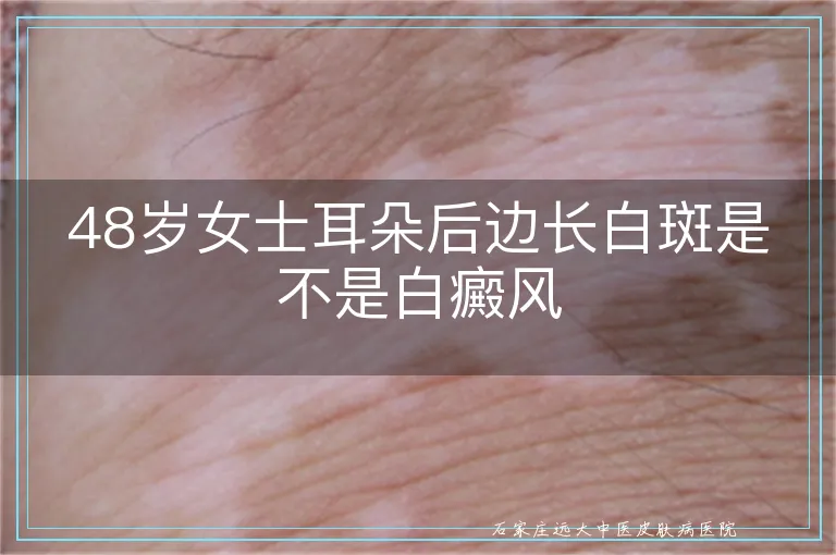 48岁女士耳朵后边长白斑是不是白癜风