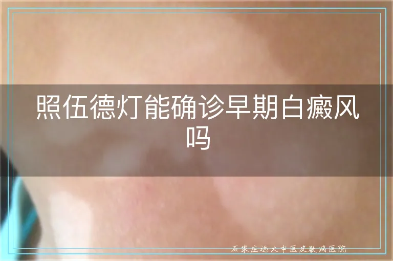 照伍德灯能确诊早期白癜风吗