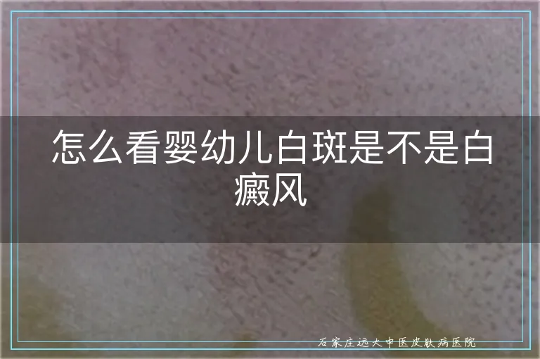 怎么看婴幼儿白斑是不是白癜风