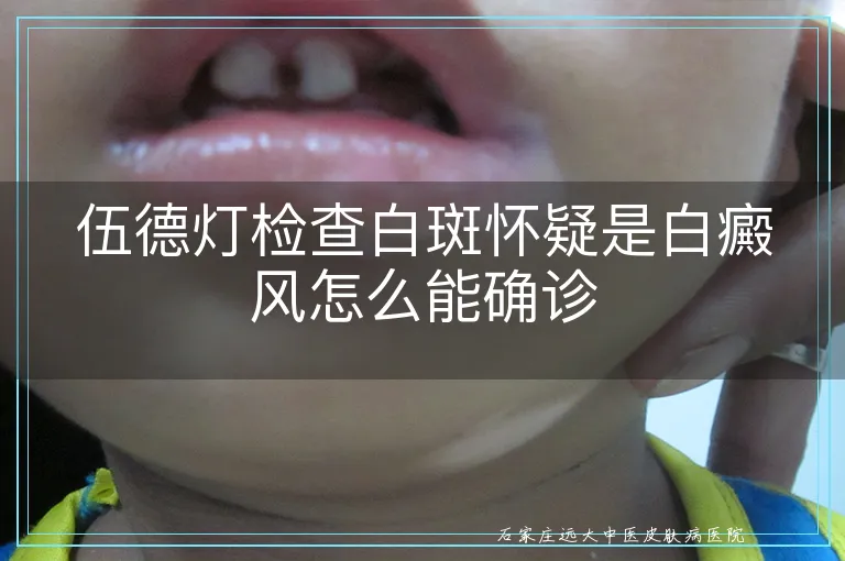 伍德灯检查白斑怀疑是白癜风怎么能确诊