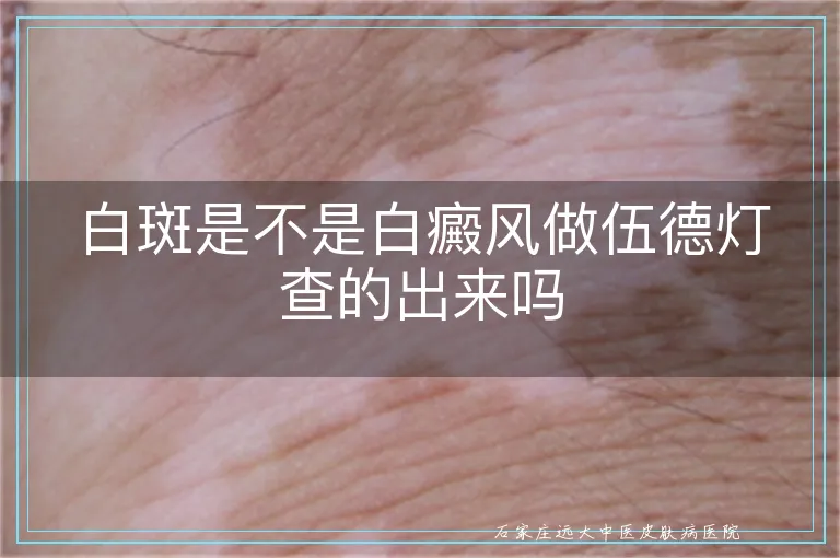 白斑是不是白癜风做伍德灯查的出来吗