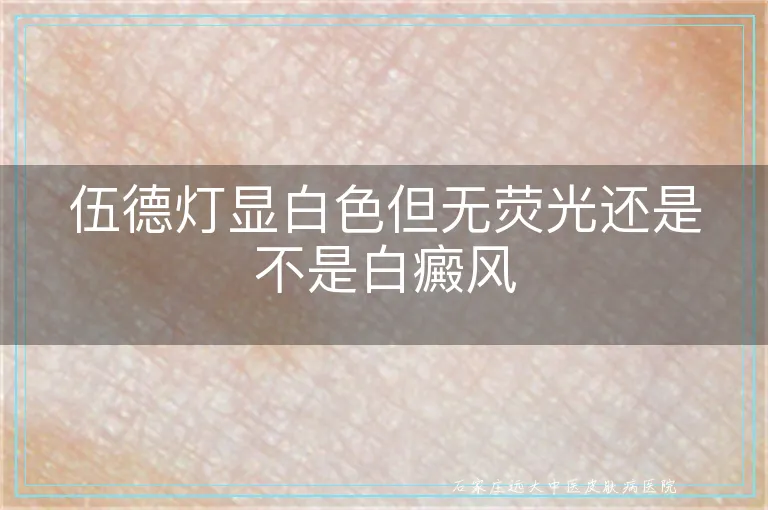 伍德灯显白色但无荧光还是不是白癜风