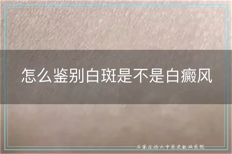 怎么鉴别白斑是不是白癜风