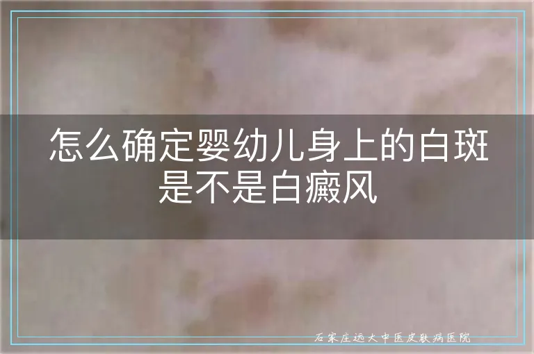 怎么确定婴幼儿身上的白斑是不是白癜风