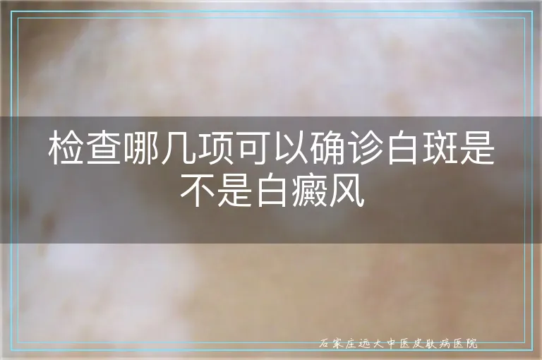 检查哪几项可以确诊白斑是不是白癜风