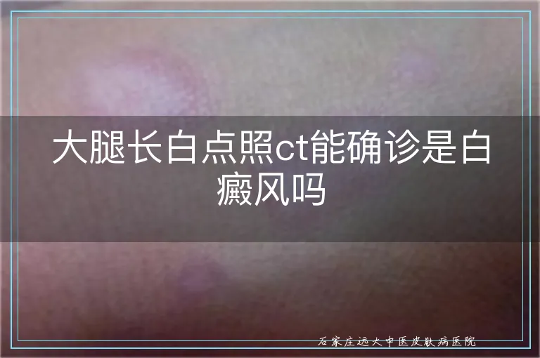 大腿长白点照ct能确诊是白癜风吗