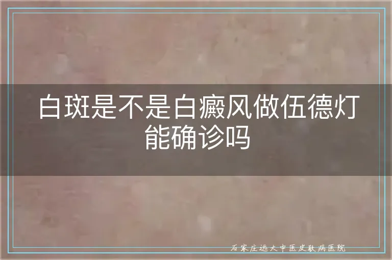 白斑是不是白癜风做伍德灯能确诊吗