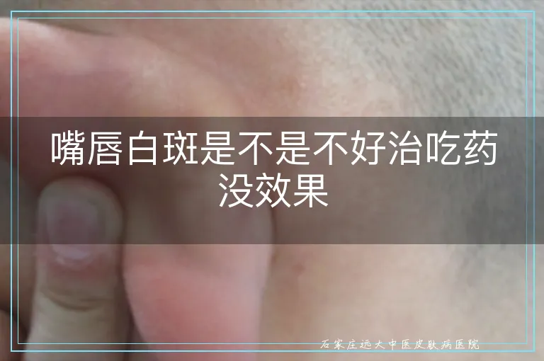 嘴唇白斑是不是不好治吃药没效果
