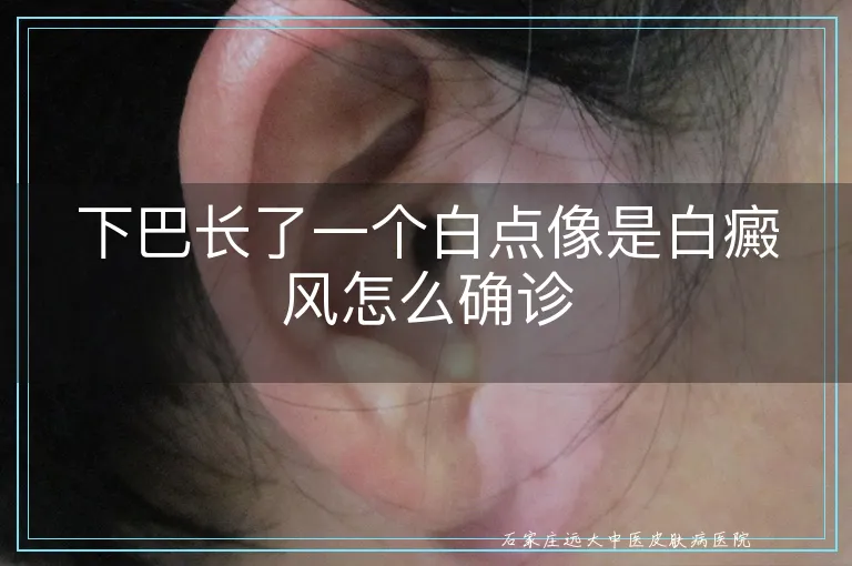 下巴长了一个白点像是白癜风怎么确诊