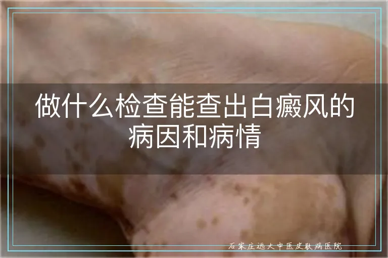 做什么检查能查出白癜风的病因和病情