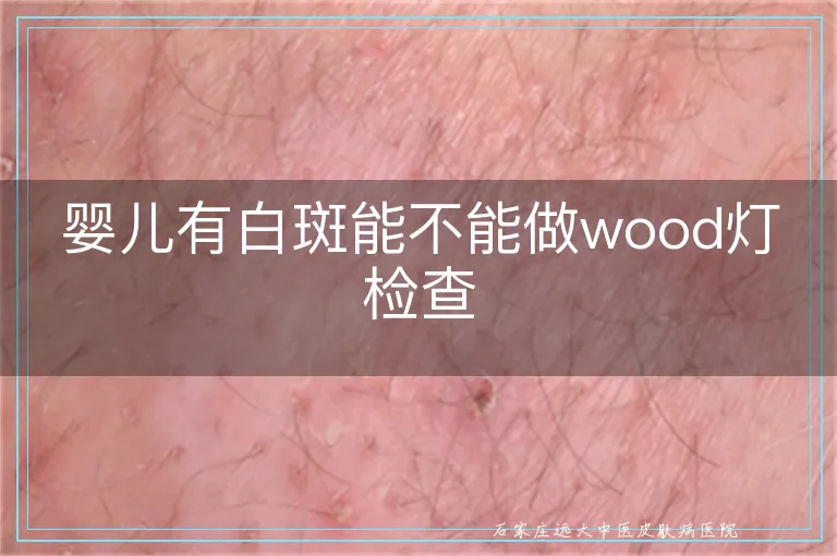 婴儿有白斑能不能做wood灯检查