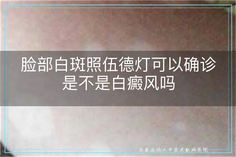 脸部白斑照伍德灯可以确诊是不是白癜风吗
