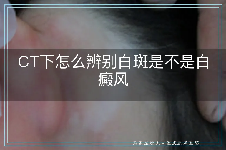 CT下怎么辨别白斑是不是白癜风