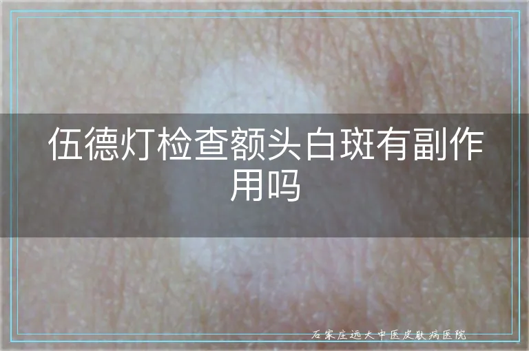 伍德灯检查额头白斑有副作用吗