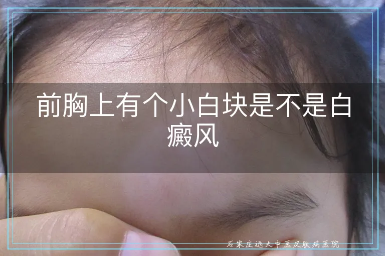 前胸上有个小白块是不是白癜风