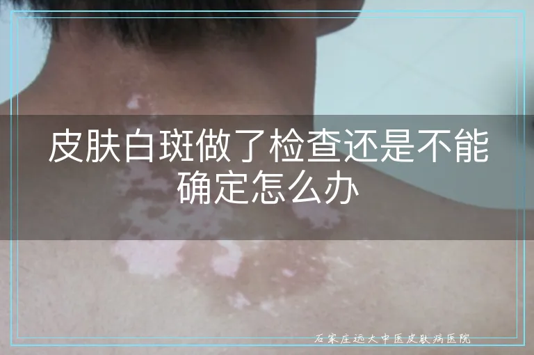 皮肤白斑做了检查还是不能确定怎么办