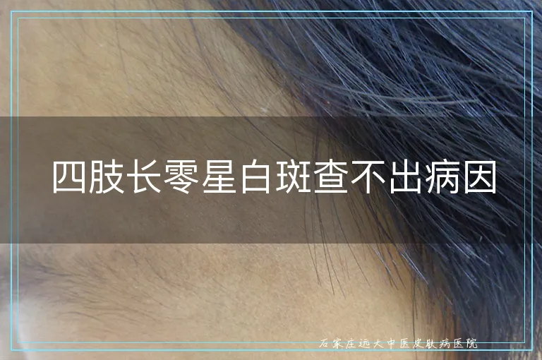 四肢长零星白斑查不出病因