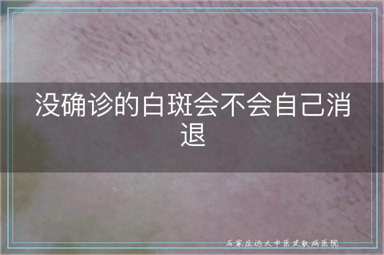 没确诊的白斑会不会自己消退