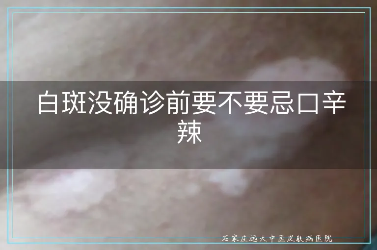 白斑没确诊前要不要忌口辛辣