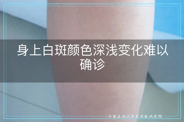 身上白斑颜色深浅变化难以确诊