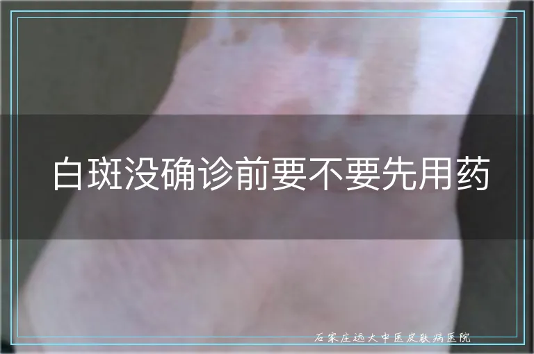 白斑没确诊前要不要先用药