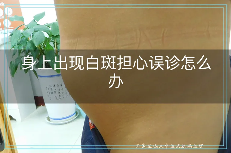 身上出现白斑担心误诊怎么办