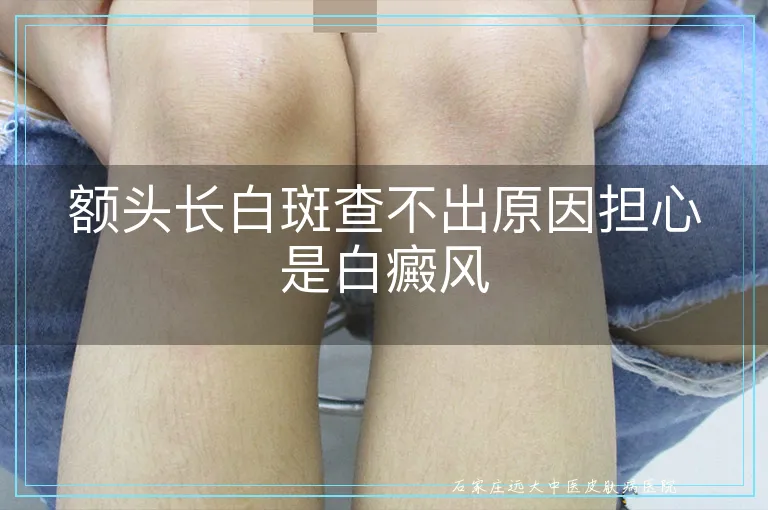 额头长白斑查不出原因担心是白癜风