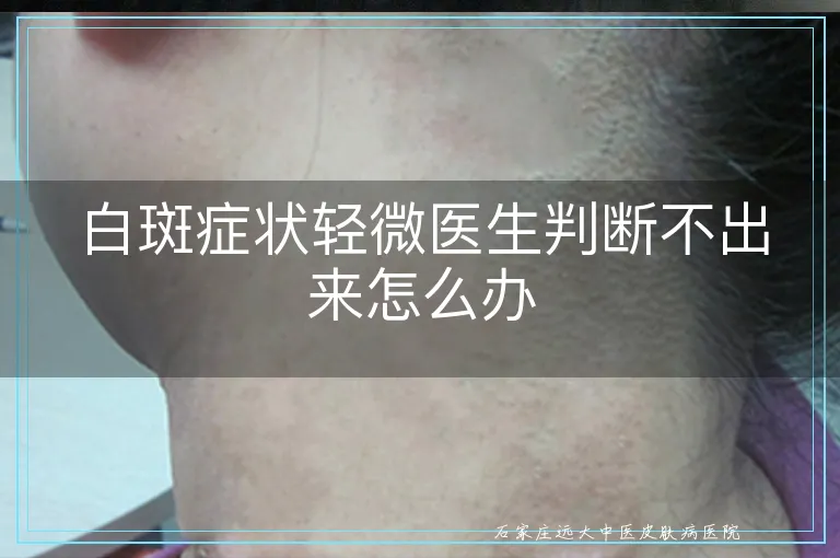白斑症状轻微医生判断不出来怎么办