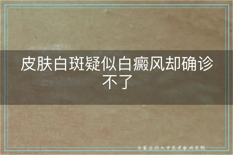 皮肤白斑疑似白癜风却确诊不了