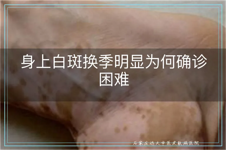 身上白斑换季明显为何确诊困难