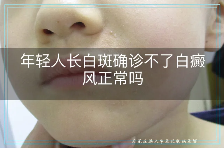 年轻人长白斑确诊不了白癜风正常吗