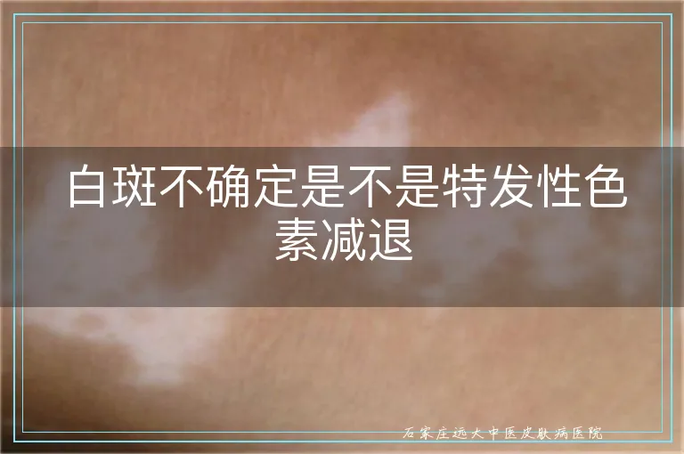 白斑不确定是不是特发性色素减退