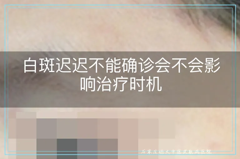 白斑迟迟不能确诊会不会影响治疗时机