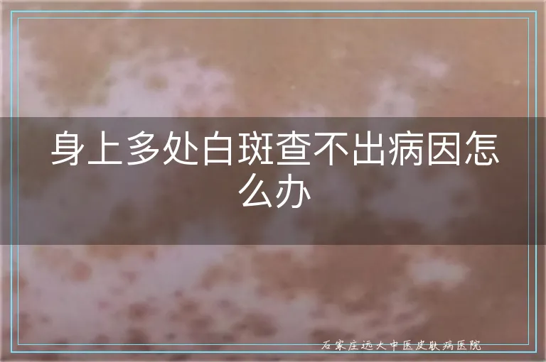 身上多处白斑查不出病因怎么办