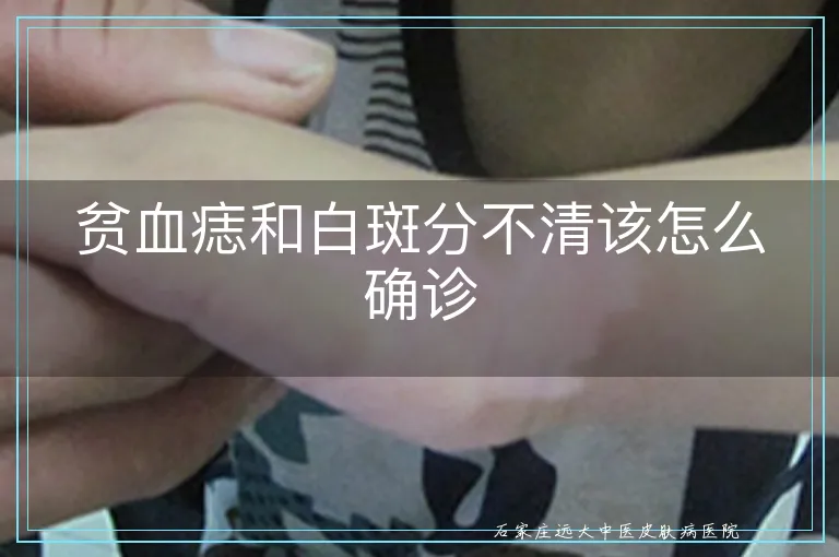 贫血痣和白斑分不清该怎么确诊