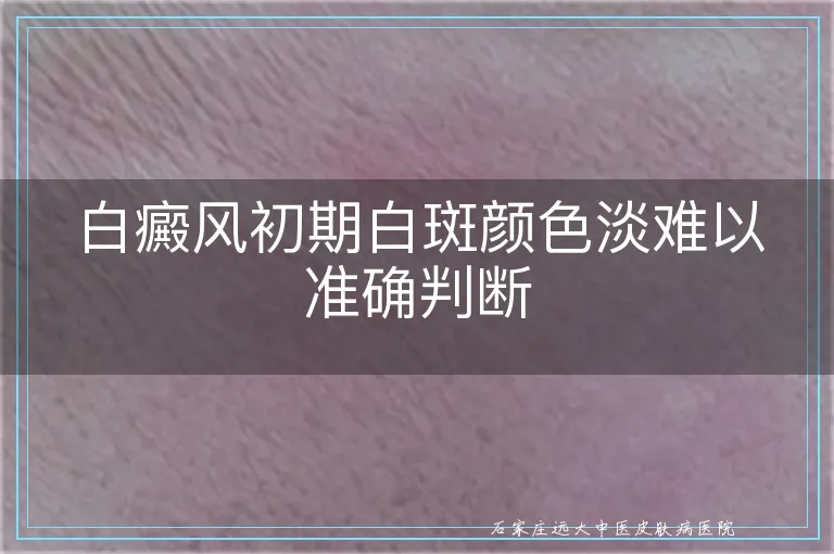 白癜风初期白斑颜色淡难以准确判断