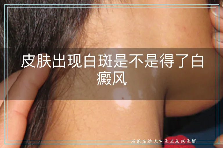 皮肤出现白斑是不是得了白癜风