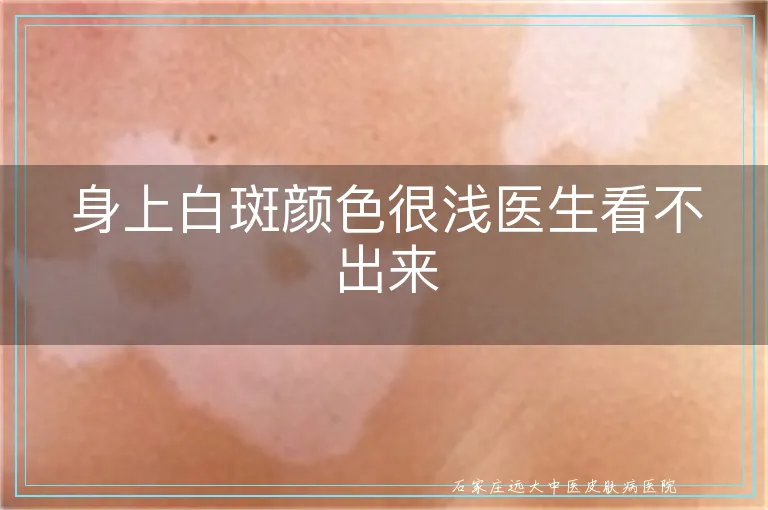 身上白斑颜色很浅医生看不出来