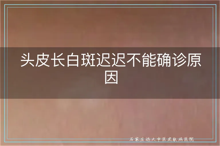 头皮长白斑迟迟不能确诊原因
