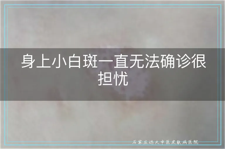 身上小白斑一直无法确诊很担忧