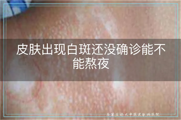 皮肤出现白斑还没确诊能不能熬夜