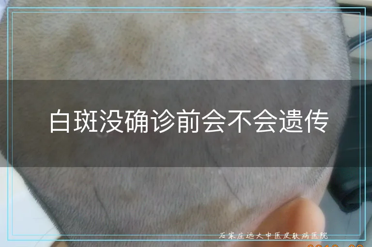 白斑没确诊前会不会遗传