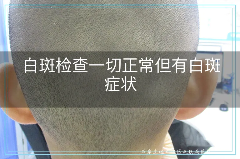 白斑检查一切正常但有白斑症状