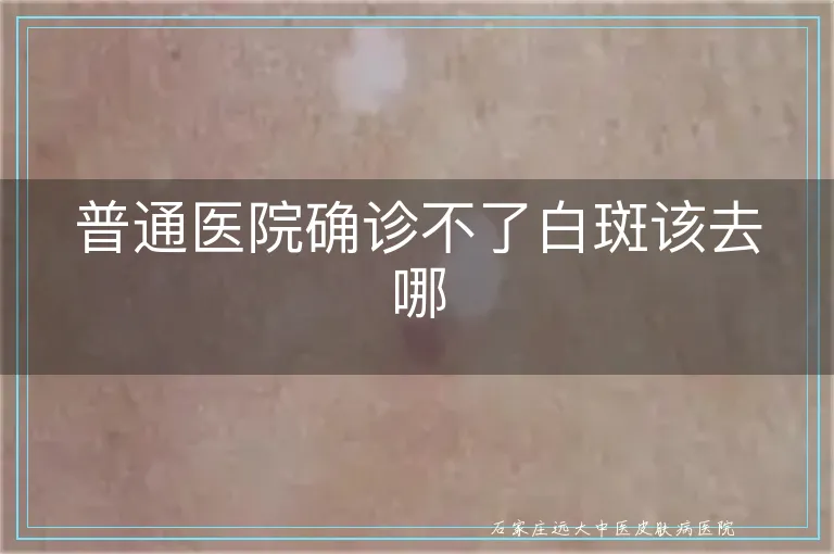 普通医院确诊不了白斑该去哪
