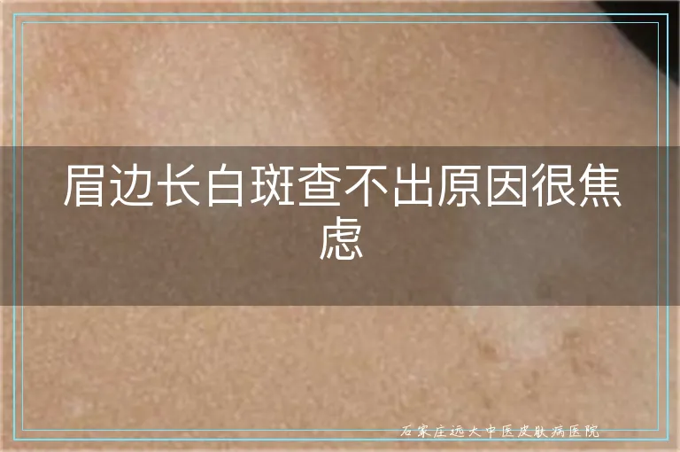 眉边长白斑查不出原因很焦虑