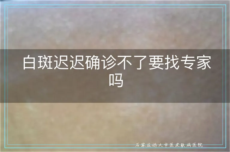 白斑迟迟确诊不了要找专家吗