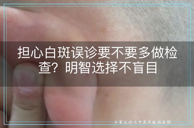 担心白斑误诊要不要多做检查？明智选择不盲目