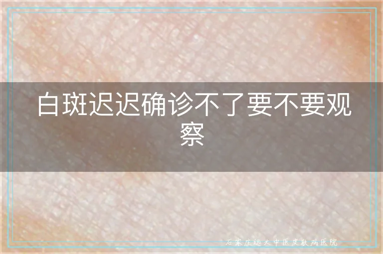 白斑迟迟确诊不了要不要观察